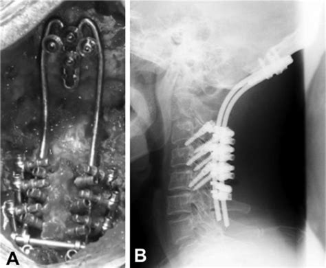 Occipito Cervical Fixation Using The Monoaxial Screw And A Rod System