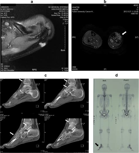 Radiological Examinations Of Pmhe A Solitary Hyperintense Nodule In