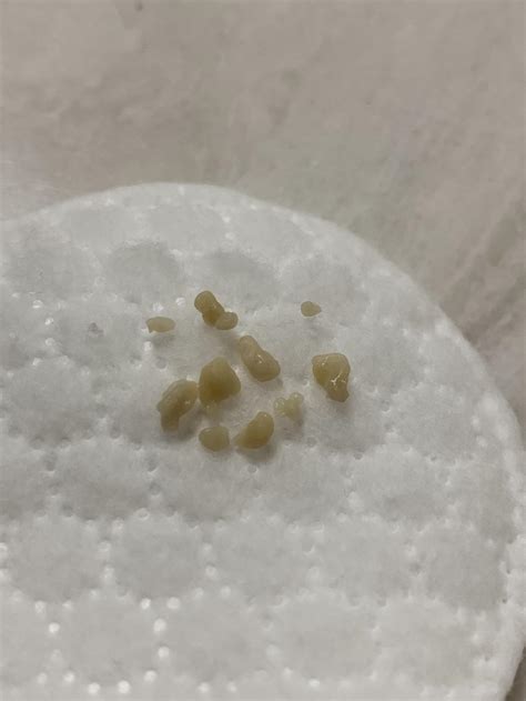 This Horrifying Mess Of Tonsil Stones Popped Out Of A Crypt I Didnt