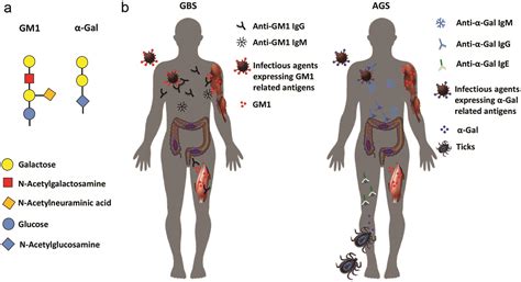 Guillain Barré And Alpha Gal Syndromes Saccharides Induced Immune