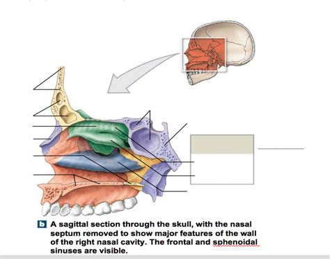 There are 5 stages for nasal cavity and paranasal sinus cancer: Sagittal Section of the Nasal Cavity Bones