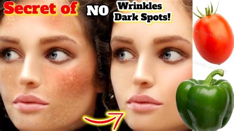 In 3 Days Remove Skin Pigmentation Melasma Dark Spots Freckles From