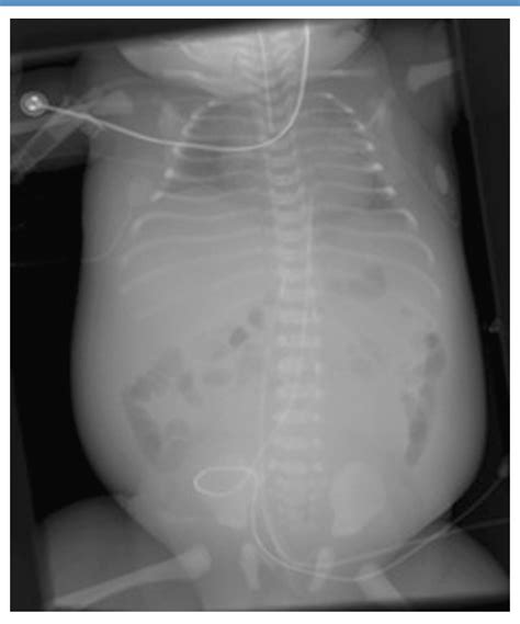 Figure From Newborn Radiographic Clues For Undiagnosed Posterior Urethral Valves Semantic