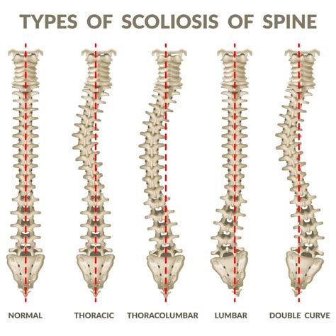 Scoliosis Treatment Without Surgery Zaker Chiropractic