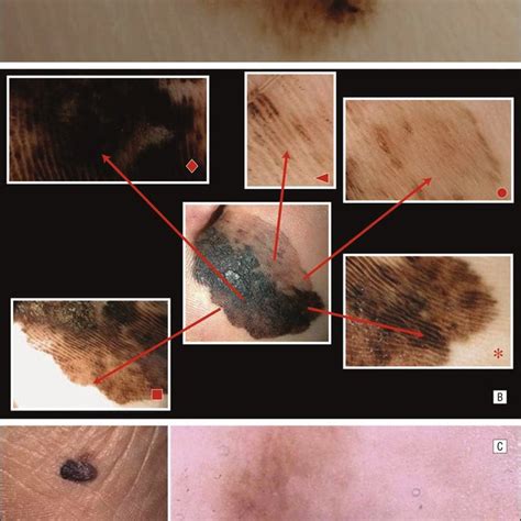 Pdf Dermoscopic Patterns Of Acral Melanocytic Nevi And Melanomas In A