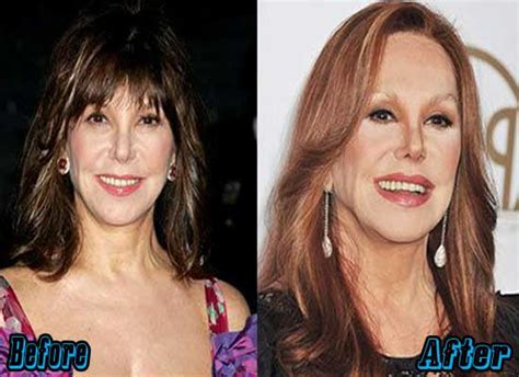 Marlo Thomas Plastic Surgery Before And After Photos Plastic Surgery