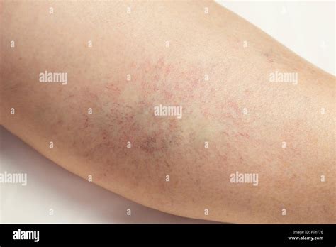 Chronic Varicose Eczema Hi Res Stock Photography And Images Alamy