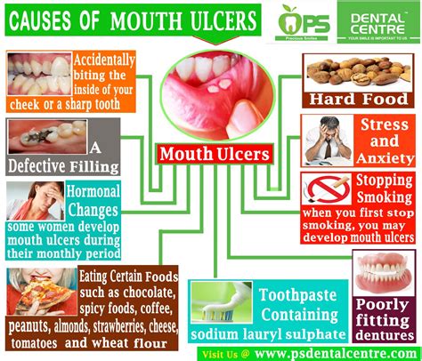 Mouth ulcers are very common, occurring in association with many diseases and by many different mechanisms. Dental Clinic In chennai | Causes of mouth ulcers, Mouth ...