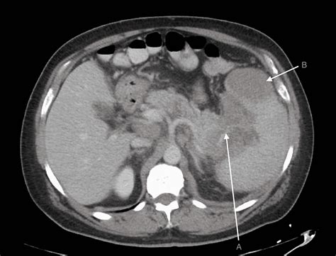 Cureus Primary Pancreatic Lymphoma In The Tail A Rare Anatomic