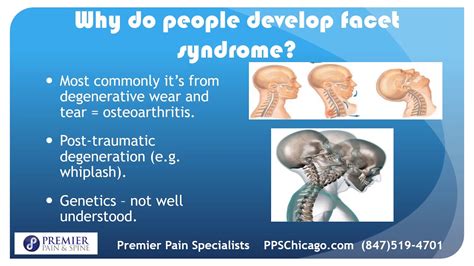 Facet Syndrome Explained By A Chicago Pain Management Clinic YouTube