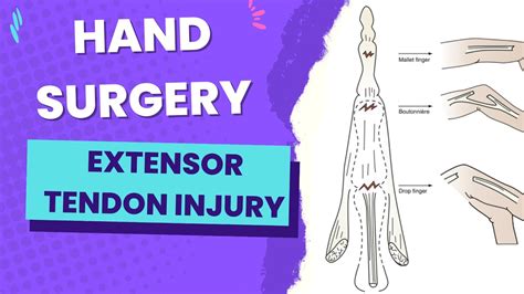 Extensor Tendon Injuries Hand Surgery Dr Neel Gupta Youtube