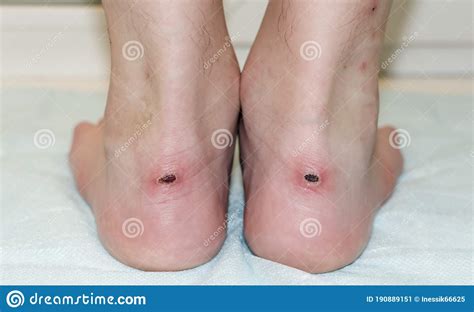 Calluses On The Ankles With Sores Stock Image Image Of Damage Bare