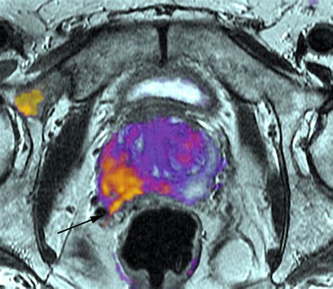 New Imaging Technique For Improved Prostate Cancer Detection And