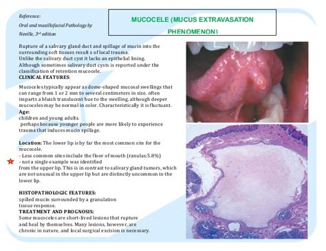 Mucocele Extravasation