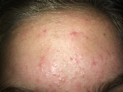 Small Bumps All Over Face And Cysts General Acne Discussion