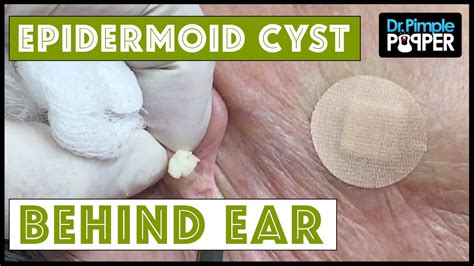Cyst And Blackheads Behind The Ear Youtube