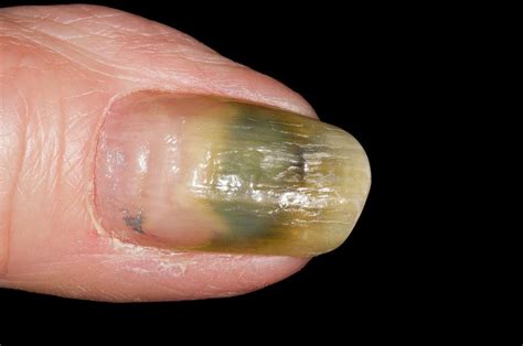 Fungal Nail Infection Of The Thumb Photograph By Dr P Marazziscience