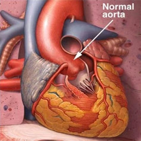 Enlarged Aorta Symptoms Treatment Surgery Pictures