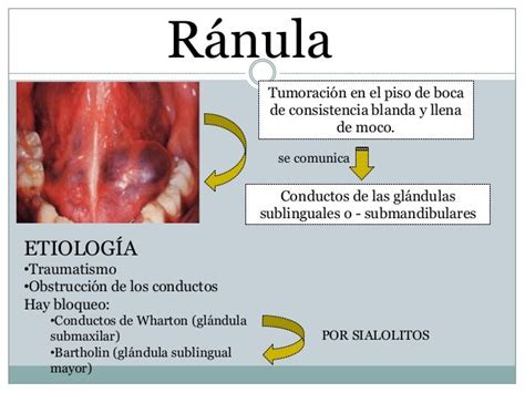 Patología Bucal Y Glándulas Salivales Otorrinolaringologia