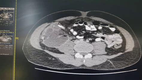Retrocecal Abscess Ct 2 Youtube