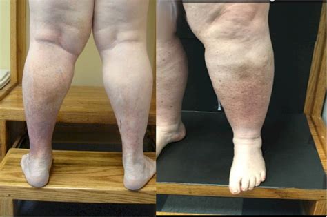 Chronic Venous Insufficiency Vein Disorders Vein Specialists Of Carolinas