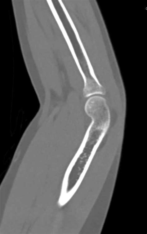 Positive Fat Pad Sign Elbow Following Trauma Trauma Case Studies