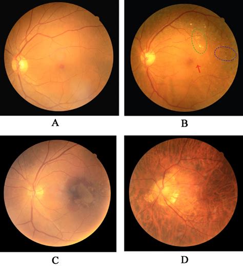 Typical Fundus Photographs In Patients With Dm A Fundus Photograph