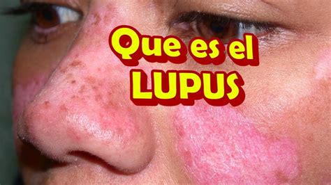 Que Es El Lupus Y Sus Sintomas Como Se Manifiesta Y Como Se Cura Youtube