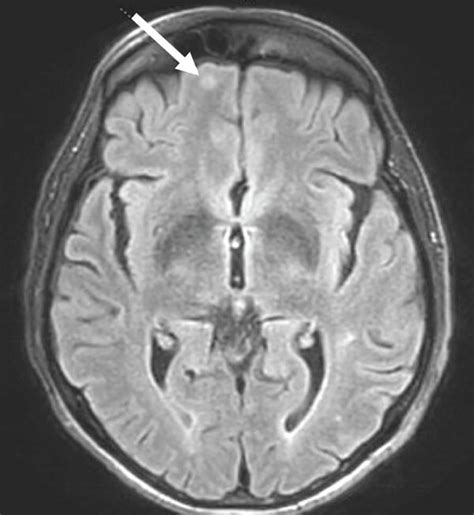 Mri With Intravenous Contrast Of The Brain And Spine Showing Subacute