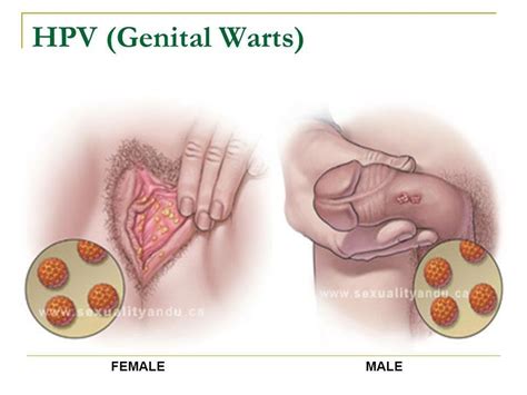 Hpv Virus Anal Warts Pictures New Porn Comments 4