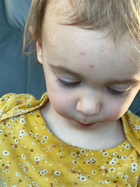Zit Looking Bumps On Forehead Babycenter