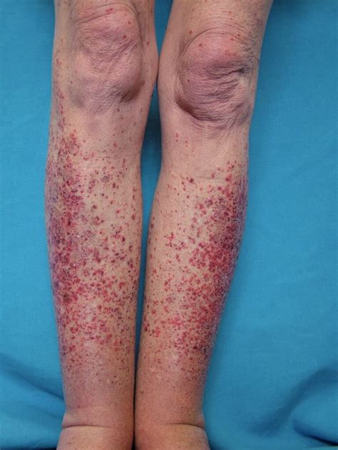 Figure Leukocytoclastic Vasculitis Dermnet New Zealand Statpearls