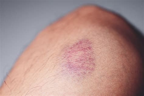 How V Beam Can Help Treat Bruises And Other Treatment Options