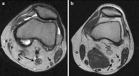 A This Axial Knee Mri Of A Patient With Charcot Marie Tooth Disease