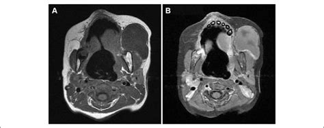 Mass In Buccal Space On Magnetic Resonance Imaging After Sclerotherapy