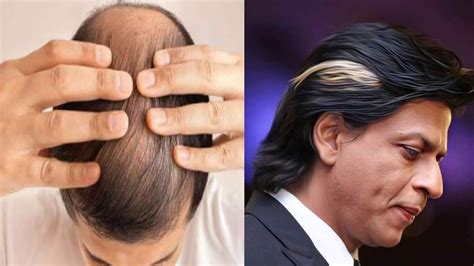 Hair Transplant Keep These Things In Mind To Remove Baldness And Get A