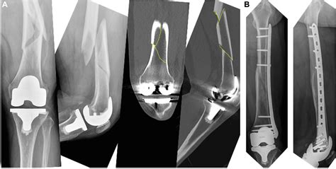 New Classification For Periprosthetic Distal Femoral Fractures Based On
