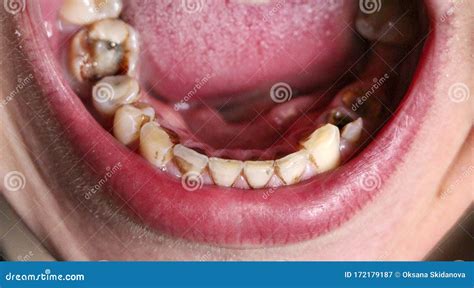 Open Mouth With Broken Diseased Teeth Affected By Caries And