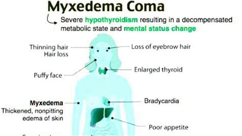 Myxedema Coma A Medical Emergency Medizzy