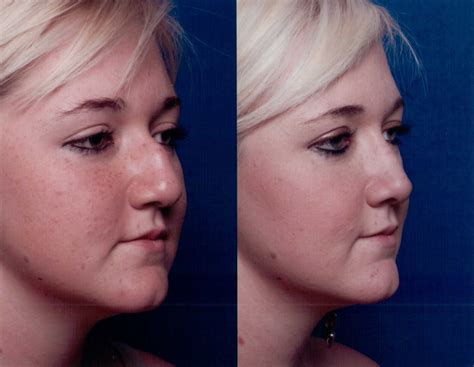The Nose Clinic Before And After Nose Surgery Photos 55