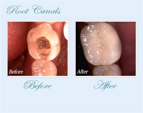 Root Canal Charleston Sc Tooth Pain Relief Inflamed Nerves