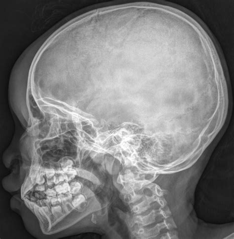 X Ray Cranium Indications Soft Tissue Sweling Radiology Imaging