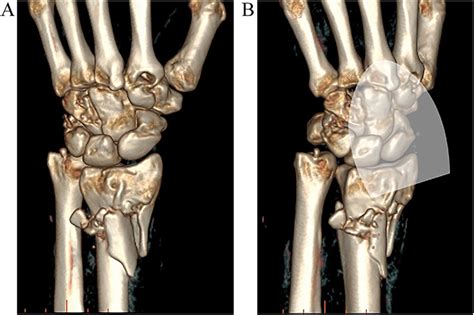 Surface Rendered 3d Ct Images A And B Show Penetrating Fractures