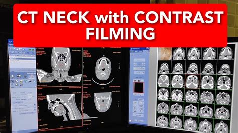Ct Scan Pns Neck Contrast Filming Youtube