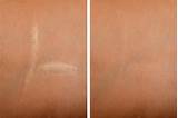 Can Makeup Cover Up Stretch Marks Photos