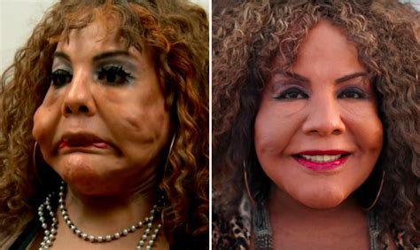 The Most Shocking Botched Plastic Surgery Transformations