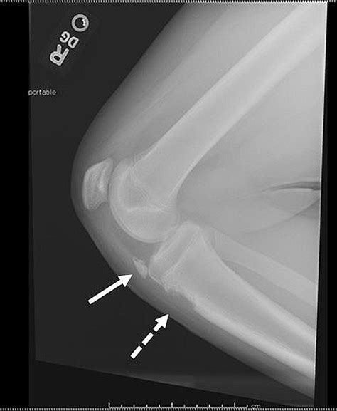 Cureus Osgood Schlatter Disease As A Possible Cause Of Tibial