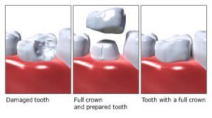 Seiring berjalannya waktu, bahan pembuat gigi palsu komposit bisa sedangkan bahan pembuat gigi palsu porselen warnanya tidak dapat berubah, karena sifat porselen yang memang. Pemasangan Gigi Palsu : Fungsi - Prosedur dan Perawatan ...