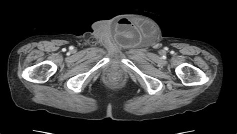 Ct Image Of A Patient With A Left Incarcerated Inguinal Hernia