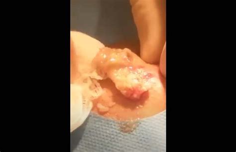 We hope you enjoy them as we do. youtube cyst popping cheese - New Pimple Popping Videos